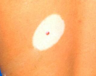 武汉白斑医院解答皮肤白癜风的治疗办法 武汉白癜风医院盘点白癜风难治吗怎么治疗