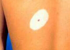 武汉环亚医院教你白癜风如何进行快速治疗 武汉治疗中的白癜风有哪些事情需要注意