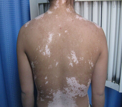 湖北白癜风医院盘点生活中预防白癜风的方式还是有很多的 武汉地区怎样治疗白癜风的方式才是正确的