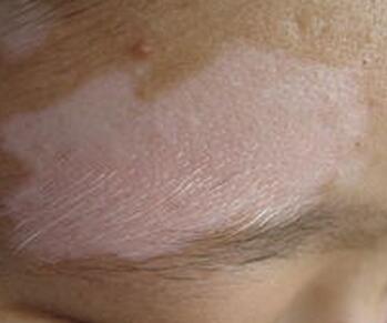 白癜风早期治好注意什么 白癜风的护理措施都有哪些