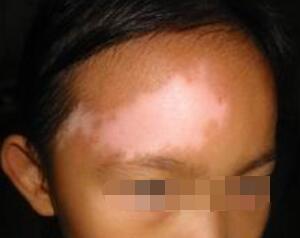 武汉白癜风治疗有哪些有效的治疗药物 武汉都有什么因素会影响到白癜风的治疗