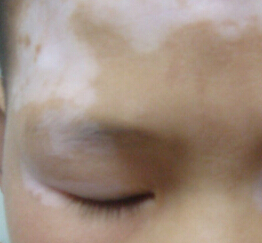 如何有效预防面部白癜风有效果 治疗面部白癜风的方法是怎样的呢