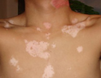 治疗白癜风需要患者注意什么 孩子皮肤出现白癜风该怎么治疗比较好