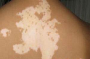 荆门白癜风医院回复生活中要如何避免白癜风的发生呢 武汉白斑医院解答治疗白癜风患者哪些是需要引起重视的