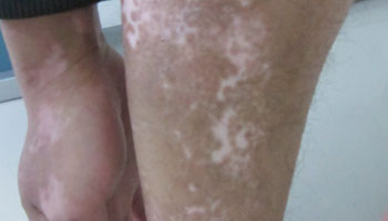 襄阳专治白癜风医院分析治疗白癜风快的方法 襄阳白癜风治疗医院提示中医治疗白癜风的方式是什么