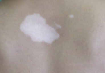 影响白癜风的治疗效果有哪些因素 武汉白斑医院推荐什么方法治疗白癜风最有效