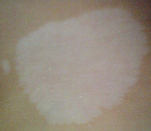 武汉哪个白癜风医院最好?白癜风早期吃什么药治疗比较好呢? 武汉哪个白癜风医院好?有哪些控制白癜风白斑的方法?