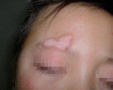 白癜风的治疗方法是怎样的呢?湖北白斑病治疗医院 湖北治疗白斑病?小心白癜风误诊误诊带来的伤害?