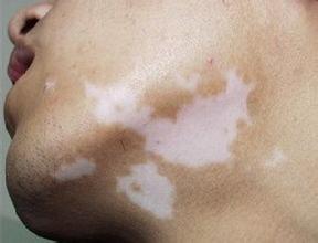 药物治疗白癜风的方式你知道几种呢?湖北白斑治疗医院 各种需要了解的白癜风的治疗方式?湖北治疗白斑最好的医院