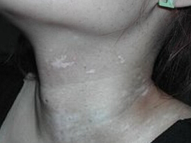 恩施白斑病医院?正确对待白癜风有助于白癜风的治疗 恩施治疗白癜风?怎样治疗白癜风安全有效