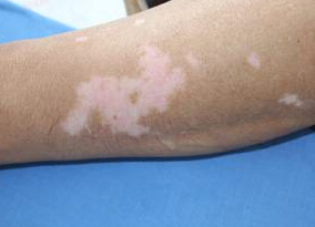 武汉白癜风治疗哪家最好?早期白癜风患者吃什么药物好呢 武汉白癜风治疗哪里比较好?白癜风患者科学保健的办法有哪些呢?