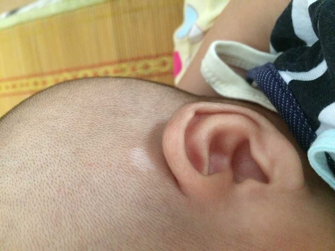 武汉哪里看白癜风好?面部白癜风症状有哪些? 武汉去哪里看白癜风?治疗儿童白癜风较快的方法是什么