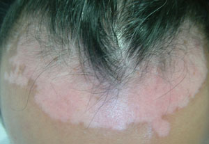 武汉看白癜风去哪家医院?是什么影响白癜风的治疗效果 武汉看白癜风怎么走?白癜风抹什么药效果好