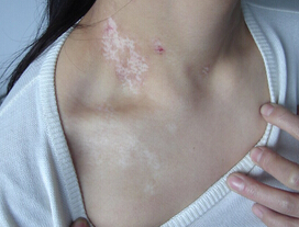 武汉白癜风较好专科医院?治疗白癜风应该记住哪几点 武汉白癜风重点医院?可以治好白癜风吗