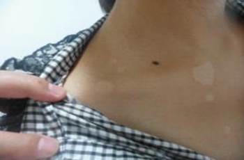 治白癜风武汉哪家好?控制白斑病的常见方法是什么 武汉哪个医院治白癜风好?治疗患者身上白斑病最有效的方法