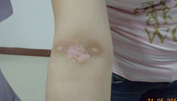 武汉白癜风治疗时要注意哪些事项 武汉治疗白癜风患者最担心什么