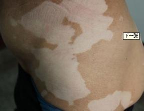 武汉白癜风的发病原因是什么 孩子白癜风的发病原因是什么会传染吗