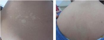 武汉怎么治疗腰部白斑比较有效?